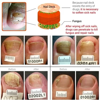 30ml de Fungos nas Unhas Tratamento de Soro de Onicomicose Paronychia Anti-Fungos nas Unhas Infecção de Ervas Dedo do pé Fungo do Pé de Reparação de Essen